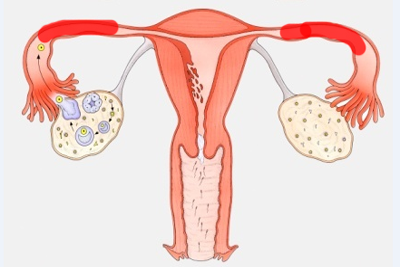女性输卵管堵塞后的症状